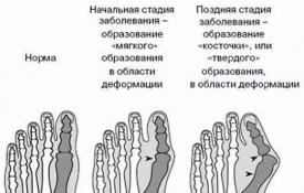 Golpes (huesos) en las piernas: tratamiento en casa.